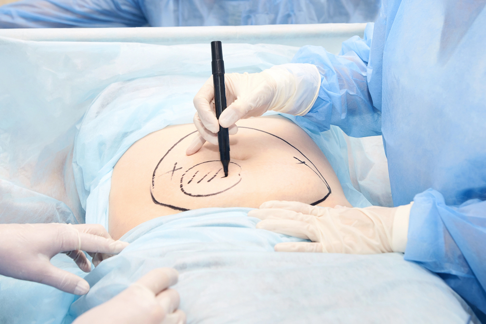 Abdominoplasty in Wellington article image