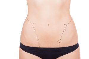 Tummy tuck and breast augmentation article image